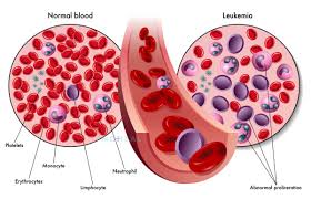 blood cancer