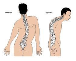 Scoliosis and Kyphosis Surgery