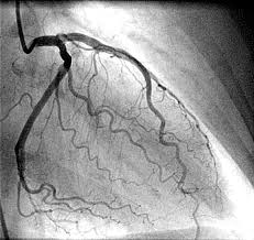 Coronary Angiography