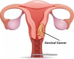 Cervical Cancer Treatment