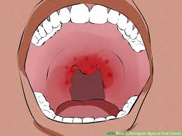 Oral Cancer Treatment