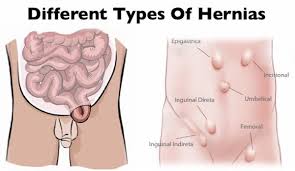 Inguinal Hernia Repair