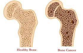 Bone Cancer Treatment