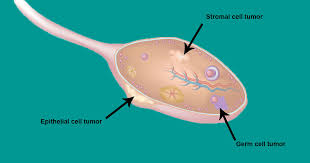 Ovarian Cancer Treatment