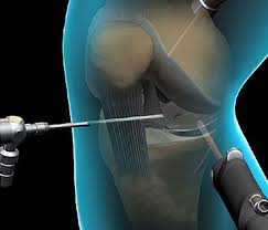 Knee Arthroscopy Surgery