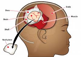 Craniotomy