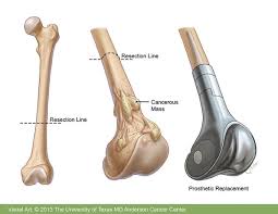 Bone Cancer Treatment