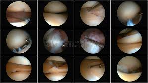 Knee Arthroscopy Surgery