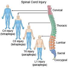 Spinal cord Injury Treatment | Aafiya International