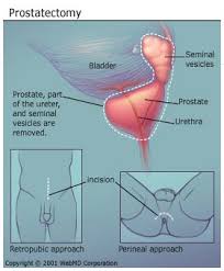 Radical Prostatectomy