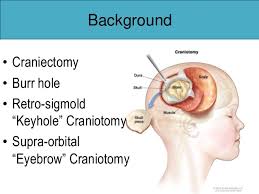 Craniotomy