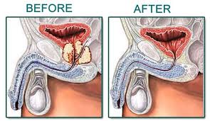 Radical Prostatectomy