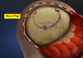 Craniotomy