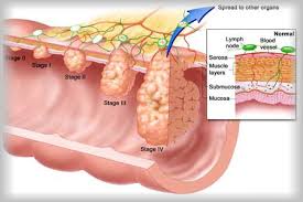 Bone Cancer Treatment