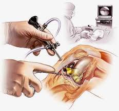 Knee Arthroscopy Surgery