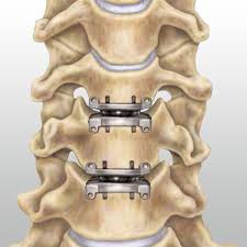 Cervical Disc Replacement