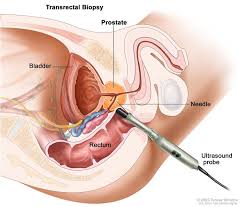 Radical Prostatectomy