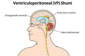 CSF Shunt Procedures