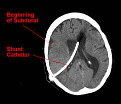 CSF Shunt Procedures