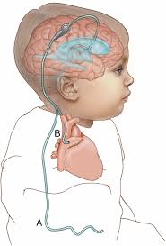 CSF Shunt Procedures