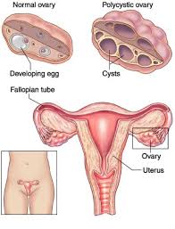 Laparoscopic Ovarian Drilling