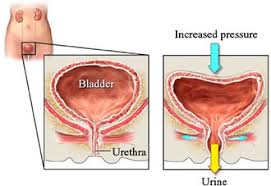 Male Urinary Incontinence