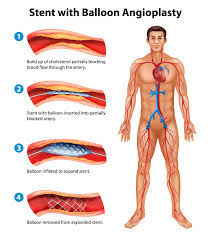 Coronary Angiography