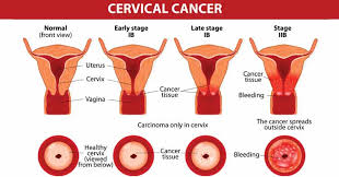 Cervical Cancer Treatment