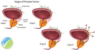 Prostate Cancer Treatment