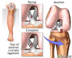 Anterior Cruciate Ligament