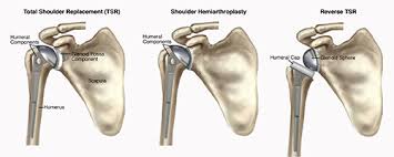 Shoulder Joint Replacement Surgery