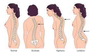 Scoliosis and Kyphosis Surgery