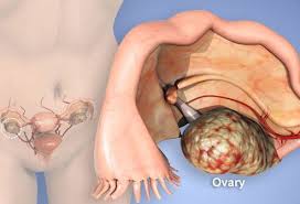 Ovarian Cancer Treatment