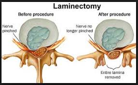 Decompressive Laminectomy