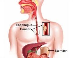 Esophageal Cancer Treatment