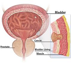 Urinary Bladder Cancer Treatment