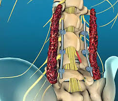 Decompressive Laminectomy