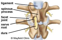 Decompressive Laminectomy