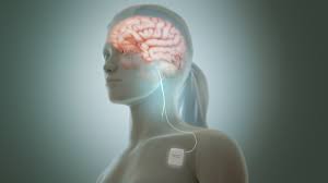 Vagus Nerve Stimulation