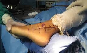 Ligaments Repair Surgery