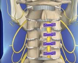 Decompressive Laminectomy