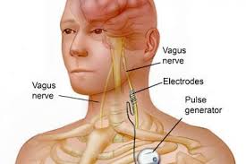 Vagus Nerve Stimulation