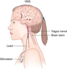 Vagus Nerve Stimulation