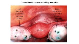 Laparoscopic Ovarian Drilling