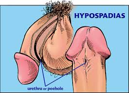 Male Hypospadias