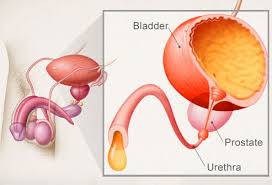 Male Urinary Incontinence