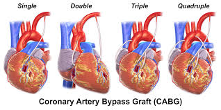 Coronary Heart Bypass Surgery