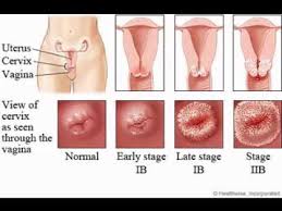 Cervical Cancer Treatment