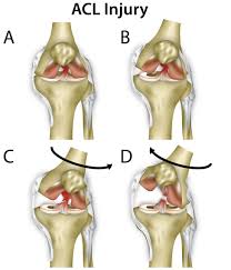 Anterior Cruciate Ligament