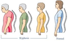 Scoliosis and Kyphosis Surgery